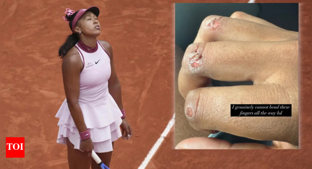 Naomi Osaka shows off gnarly blisters, says “I can’t bend my fingers,” hints at tennis break
