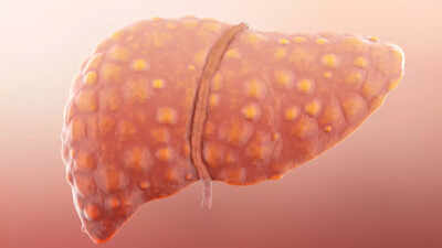 Can a dietary supplement provide the first effective treatment for liver cirrhosis?