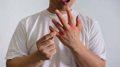 5 signs of increased uric acid seen in body-- 3 simple steps to fix it