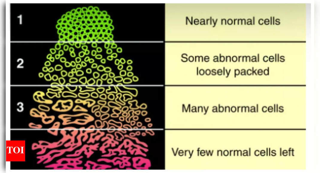 Prostate Cancer: What is the Gleason score in prostate Cancer and why early testing is crucial | – Times of India