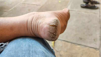 5 health warning signs in the feet you should not miss