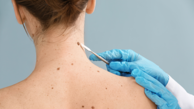 Skin cancer or something else? 5 signs no one should ignore