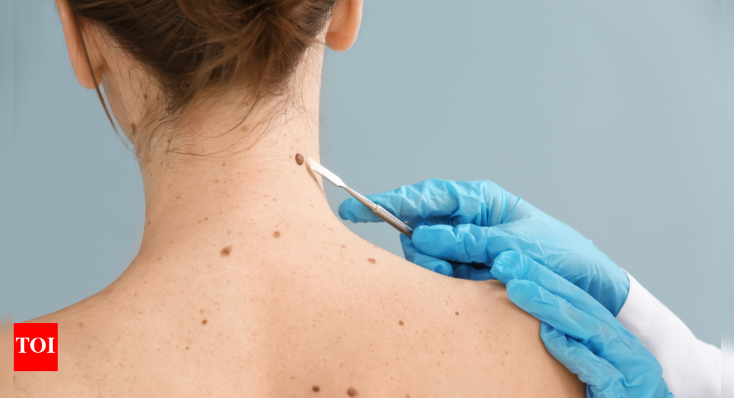 Spotting Skin Cancer: Five Signs to Watch Out For