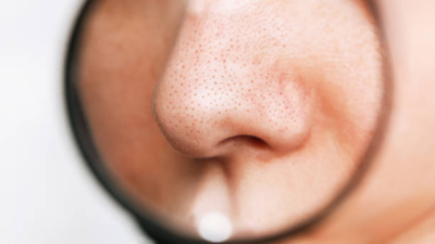Can rice water remove blackheads and shrink your pores?