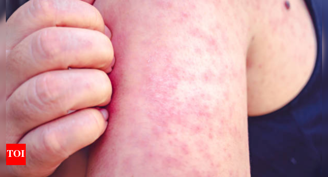 The Resurgence of Measles: Understanding the Causes and Preventative Measures