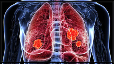 6 early symptoms of Lung Cancer that are easily ignored