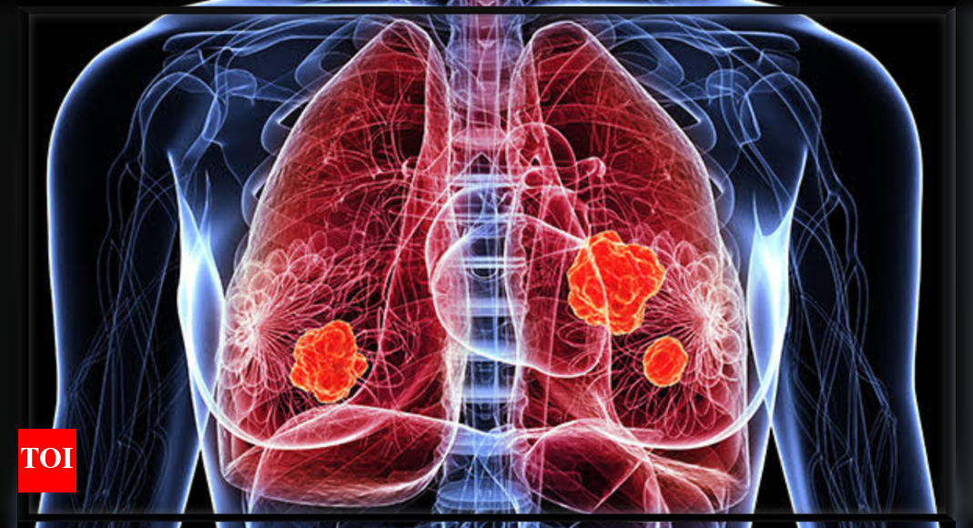 Lung Cancer Symptoms: 6 early symptoms of Lung Cancer that are easily ignored | – Times of India