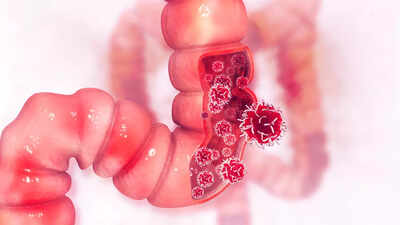 More powerful than pills? How this common practice helped colon cancer survivors live longer