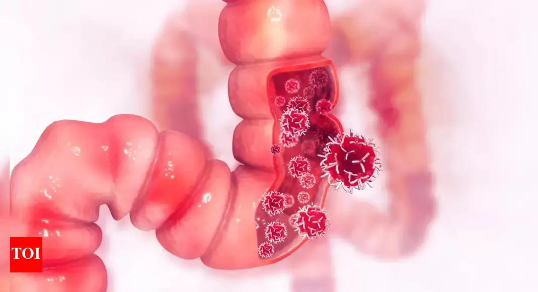 Colon Cancer: More powerful than pills? How this common practice helped colon cancer survivors live longer | – Times of India