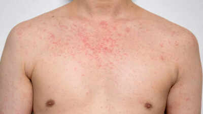 World’s most contagious disease threatens millions after case reported in Texas