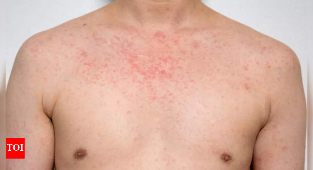 World’s most contagious disease threatens millions after case reported ...
