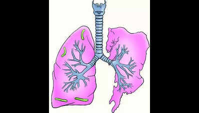 3 kids die of TB as general physicians miss early signs