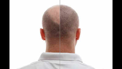 Hair transplant goes awry, clinic asked to pay 6 lakh