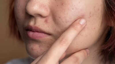 4 ways fatty liver disease can show up on your face