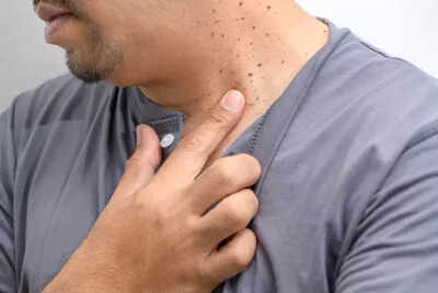Skin tags vs warts vs moles: How to tell the difference