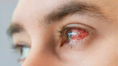 What causes conjunctivitis? Symptoms, types, and treatment you should know