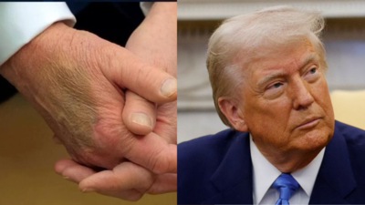  Medical experts weigh in on Trump’s 'bruised' hand; press sec dismisses speculations