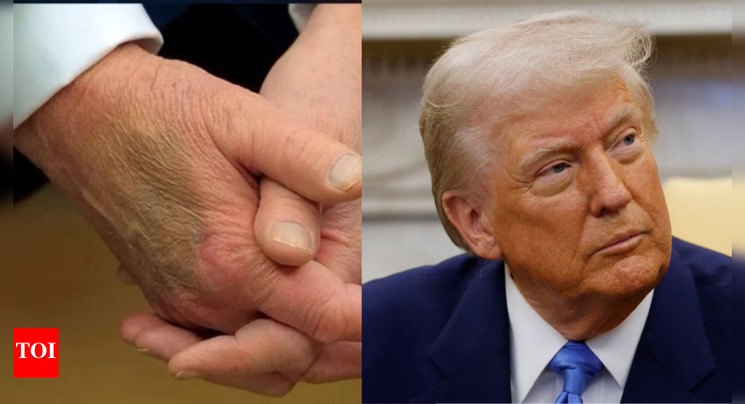 'They are trying to hide...': Medical experts weigh in on Trump’s 'bruised' hand; press sec dismisses speculations