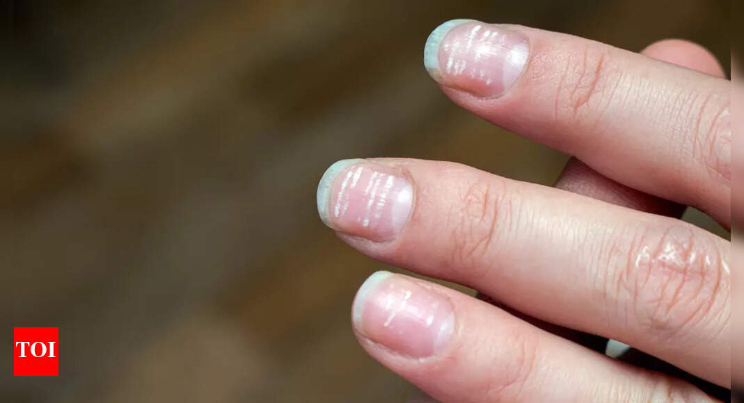 What are the tiny white spots on the nails? Top functional medicine doc says it could be a warning sign | – Times of India
