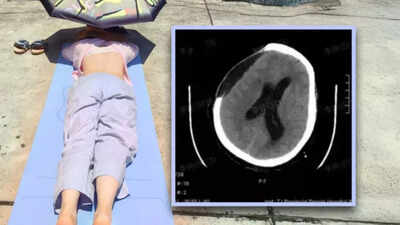 Chinese woman suffers brain hemorrhage, slips into coma after sunbathing during extreme heatwave; know the safe limit and health risks