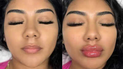 லிப் ஃபில்லர்கள் பாதுகாப்பான மற்றும் பயனுள்ளதா? நீங்கள் முயற்சிக்கும் முன் அபாயங்கள் மற்றும் என்ன கருத்தில் கொள்ள வேண்டும் என்பதை அறிந்து கொள்ளுங்கள்