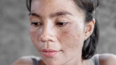 Understanding hyperpigmentation: Causes, types, prevention tips and more