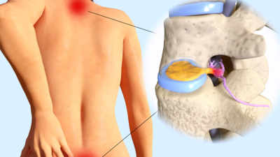 Disc Herniation: 4 exercise that can bring relief