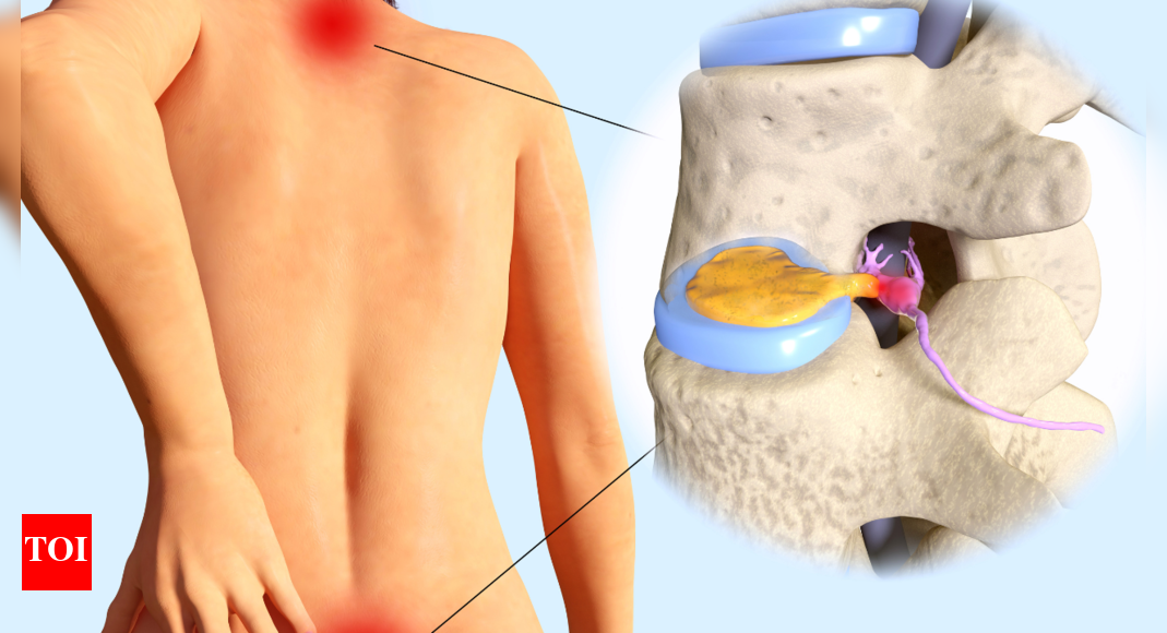 Disc Herniation: 4 exercise that can bring relief | – Times of India