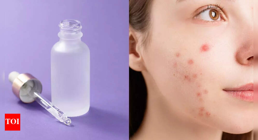 How to use salicylic acid safely for acne: Benefits, tips to use, and precautions