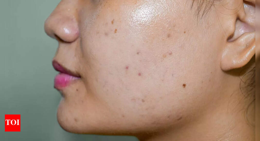 How to get rid of dark spots from face: Lifestyle tips and other ways