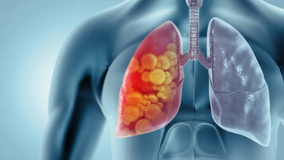Lung illness: Guy given three hundred and sixty five days to reside after marvel prognosis; what you wish to have to find out about IPF | – Instances of India