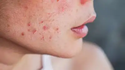 How to know if your acne is actually a fungal infection: What is fungal acne, its causes, symptoms, and more
