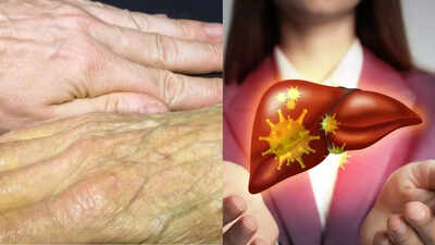 5 skin symptoms of liver disease that you should never ignore, according to a Harvard expert