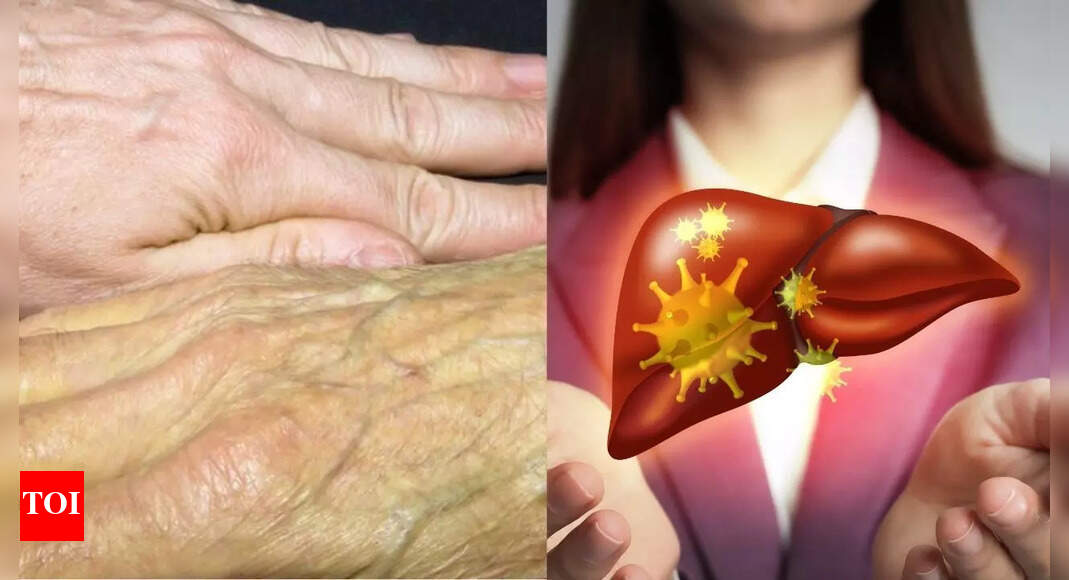 5 skin symptoms of liver disease that you should never ignore, according to a Harvard expert | – Times of India