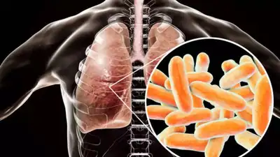 What is Legionnaires' disease? Know causes, symptoms, risk factors, prevention and more