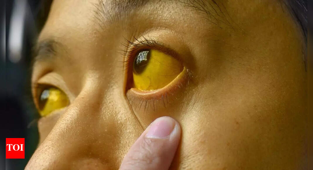 Jaundice, the yellowing of skin and eyes: Why it happens | – Times of India