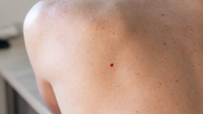 Cherry angiomas: Are those red bumps on your skin linked to cancer or liver diseases?