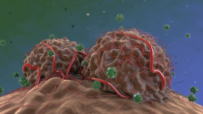  Understanding pediatric soft tissue tumors