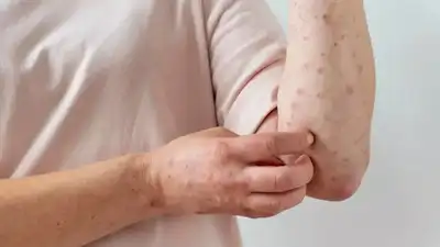  All about the symptoms, risk factors, and prevention