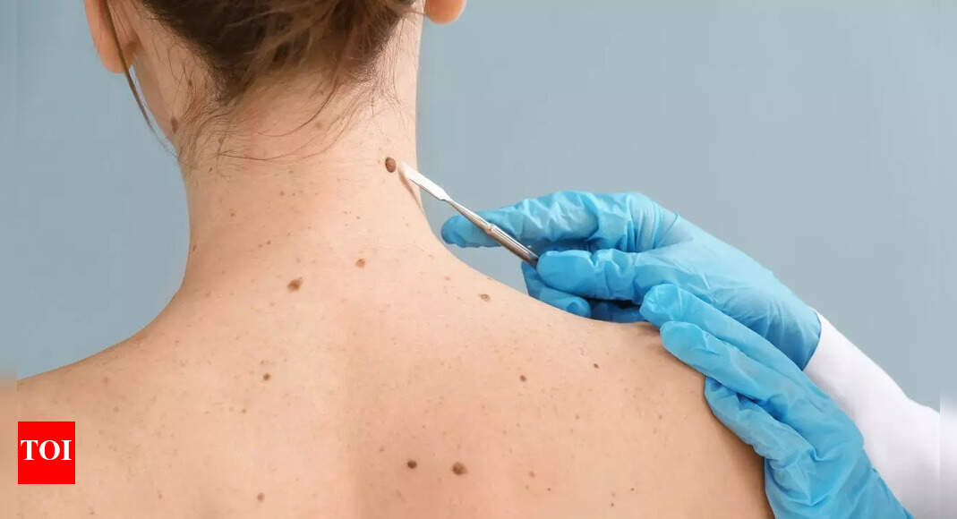 Skin cancer symptoms you might miss and how to spot them early