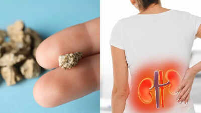 Do kidney stones increase the risk of kidney cancer? Understanding the link between the two