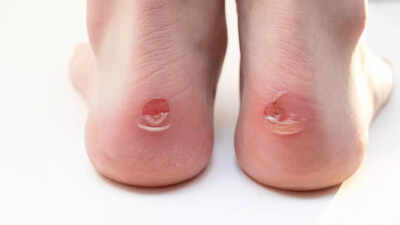 How to heal blisters safely at home with natural remedies and prevention tips