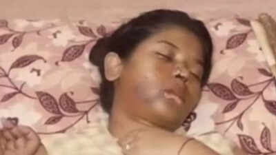 Cheek split in 2 parts: BBA student attacked by stray dogs in Kanpur; receives 17 stitches