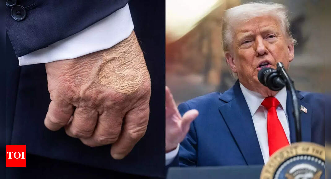What’s going on with Donald Trump’s hands? Viral photos show large blotches of 'foundation' on POTUS' hands