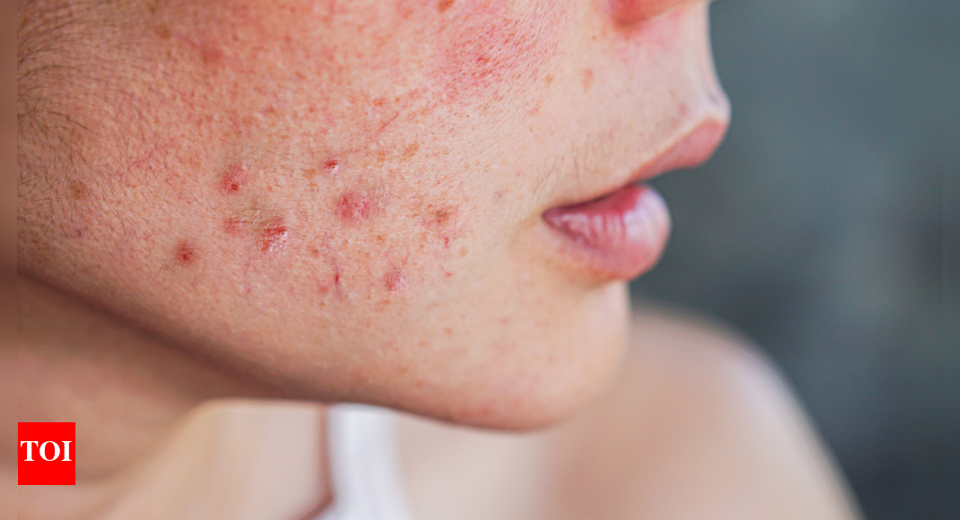 From digestive issues to hormone problems: 4 health conditions acne reveals