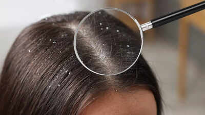 What is sticky, oily dandruff: Know its causes, why regular shampoo fails, and how to manage