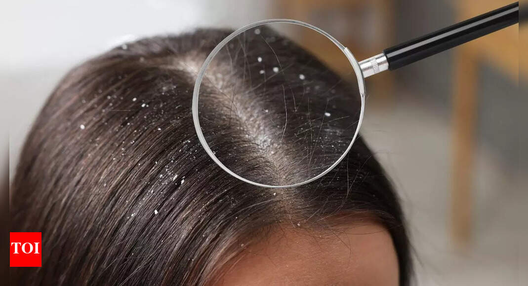 What is sticky, oily dandruff: Know its causes, why regular shampoo fails, and how to manage