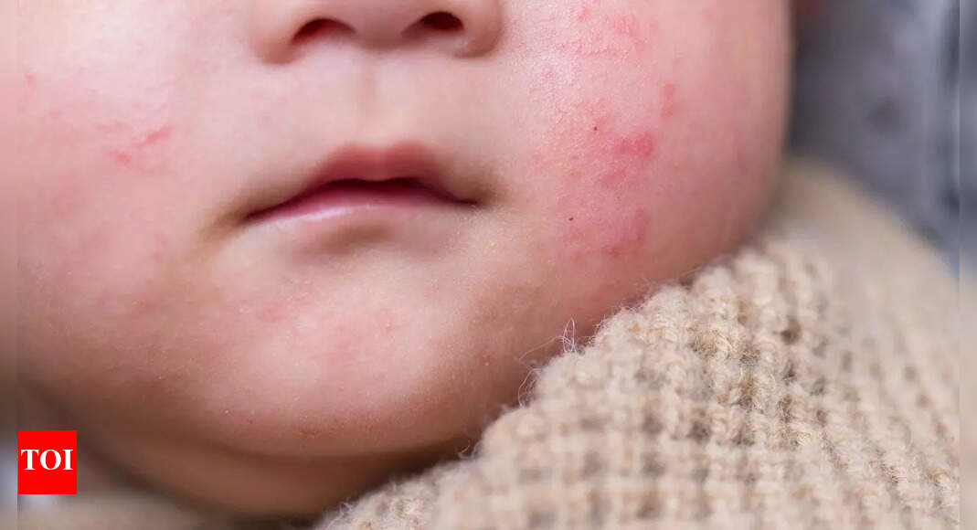 That red line on your child’s face could be a serious warning: Lymphangitis in children