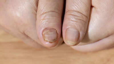 https://static.toiimg.com/thumb/msid-123598530%2Cimgsize-24652%2Cwidth-400%2Cresizemode-4/brittle-nails-could-be-a-sign-of-serious-health-problems-causes-and-underlying-conditions-explained.jpg