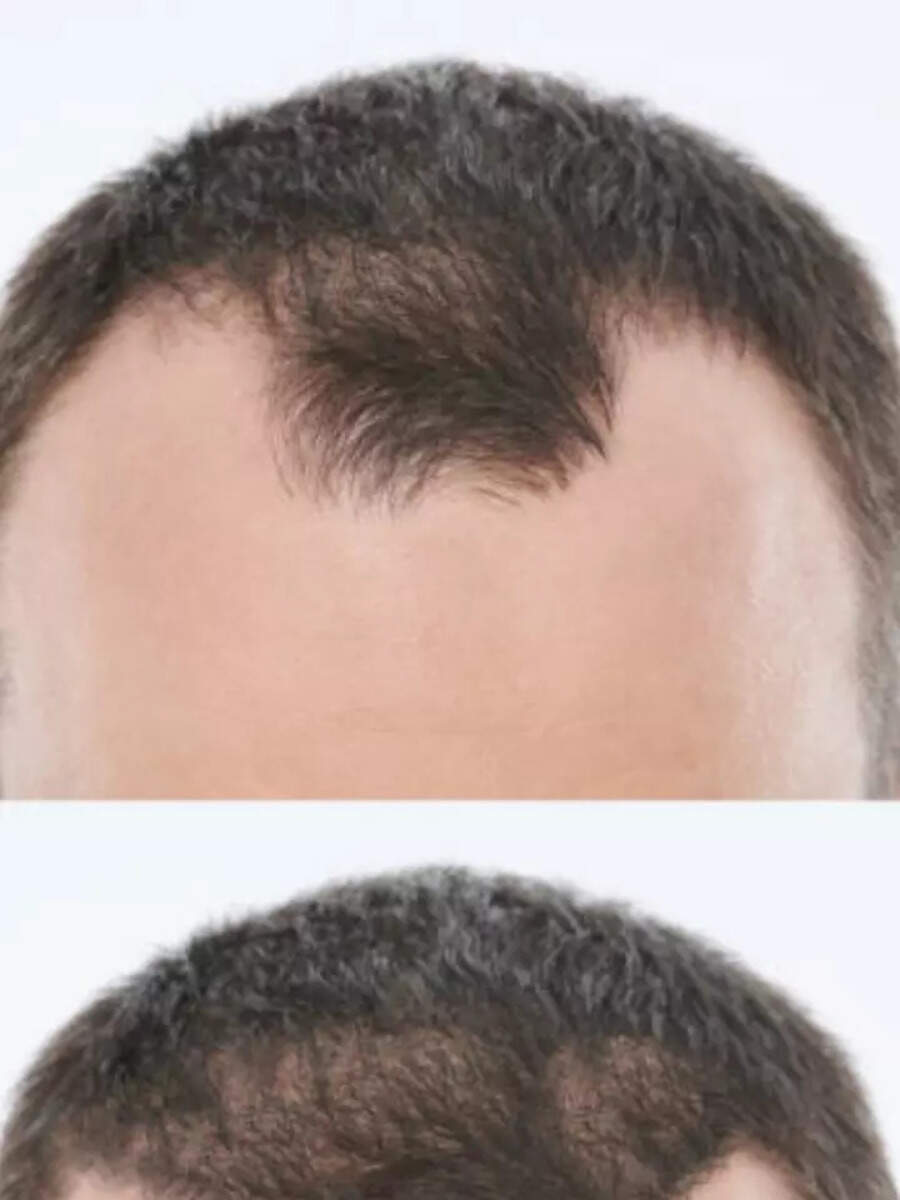 7 foods that can help prevent hair loss